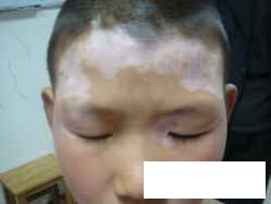 白癜风对于青少年绝对的影响