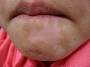 脸上出现小白块白癜风怎么选择治疗