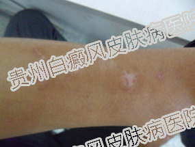 男性白癜风(白斑)患者怎么保养?