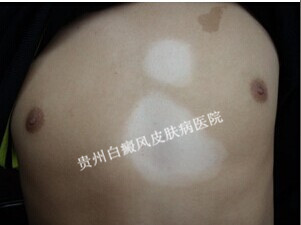 怎么诊断胸部白癜风?