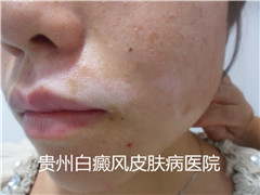 详细为您介绍白癜风的危害有哪些