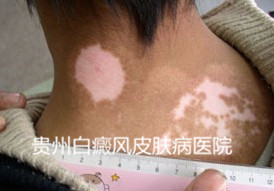 白癜风早期症状有哪些