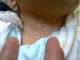 发生局限性白癜风的原因是什么?