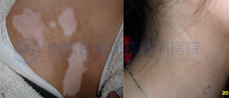 专家教你如何预防局限型白癜风