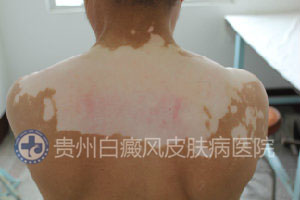 白癜风病情加重前有哪些症状