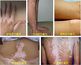 老年人白斑病应该如何识别呢?