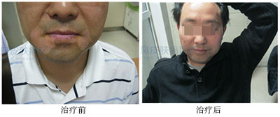 如何更好地护理老年白癜风