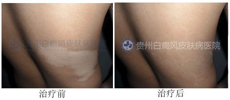 背部白癜风怎么护理?