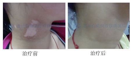 专家解析颈部白癜风早期症状及治疗