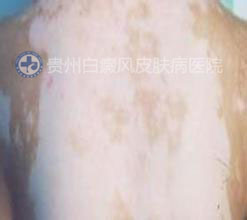 后背白癜风比较大怎么治疗才能恢复