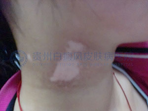 颈部白癜风早期有哪些症状表现