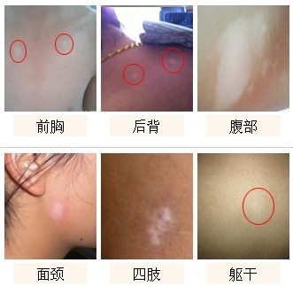 白癜风的症状有哪些?