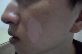 白癜风饮食需注意哪些?