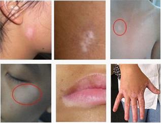 白癜风初期症状