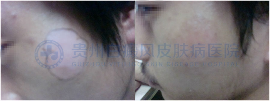 白癜风遗传吗?