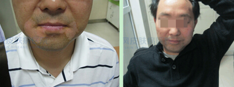 白癜风治疗要花多少钱?