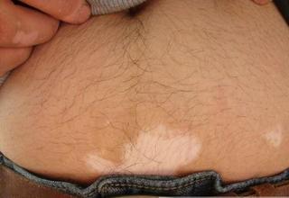 ÈçºÎÖÎÁƶùͯ°×ñ°·çƤ·ô²¡