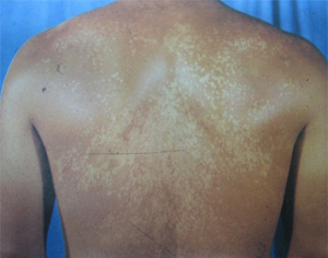 白癜风的症状有哪些?