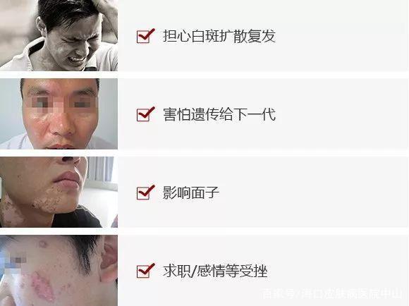 患上白癜风会有哪些症状表现