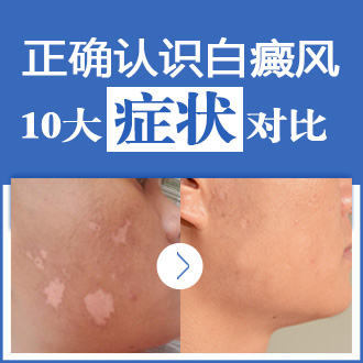 贵州看白癜风的医院哪家好?